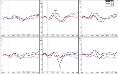 Interaction of Background Noise and Auditory Hallucinations on Phonemic Mismatch Negativity (MMN) and P3a Processing in Schizophrenia